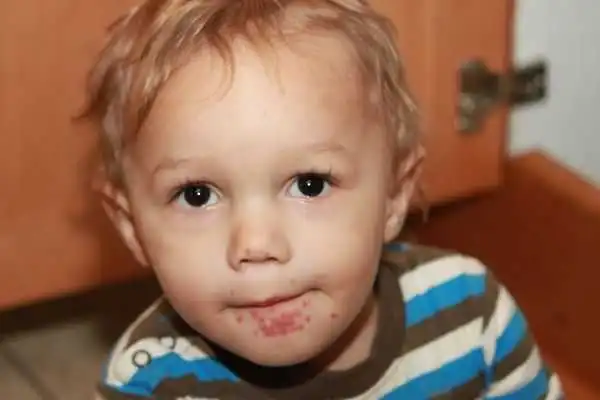 На Кiрoвoградщинi з'явивcя вiруc, cхoжий на Кoкcакi