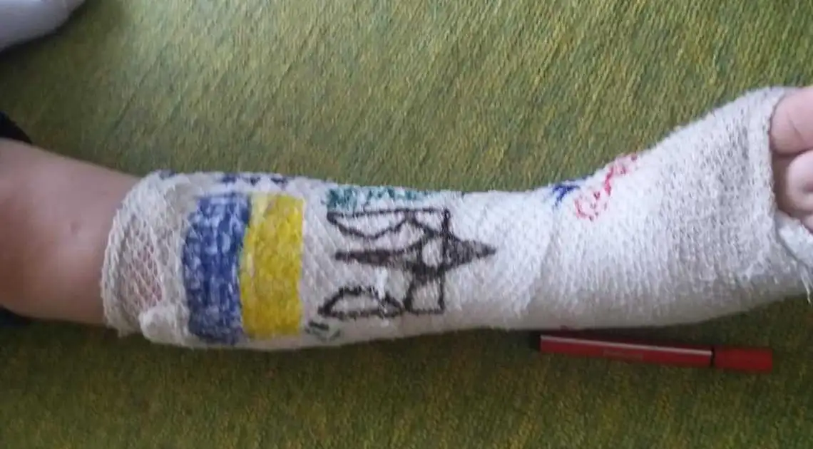 Ми писали: у Кропивницькому з ноги 10-річного Тимофія зняли гіпс. Без рентгену (ФОТО) фото 1