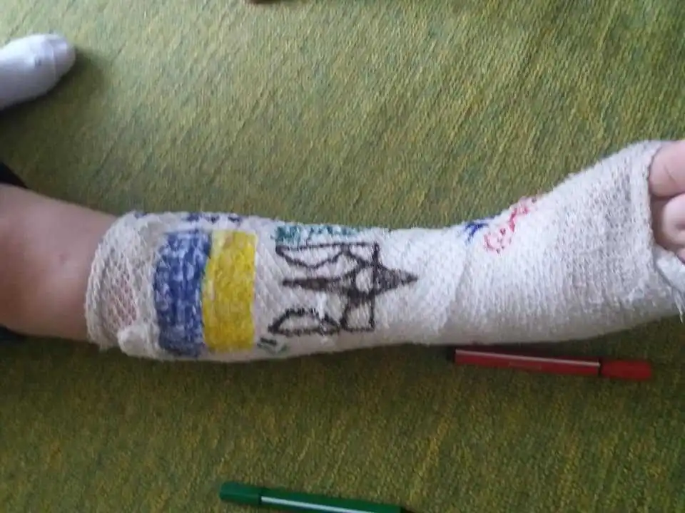 Ми писали: у Кропивницькому з ноги 10-річного Тимофія зняли гіпс. Без рентгену (ФОТО)