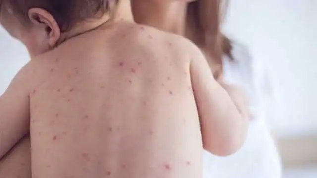 На Кіровоградщині з початку року зареєстрували 162 випадки кору