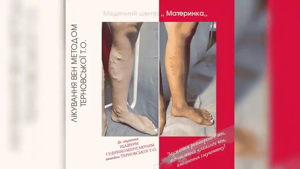 лікування вен у Кропивницькому