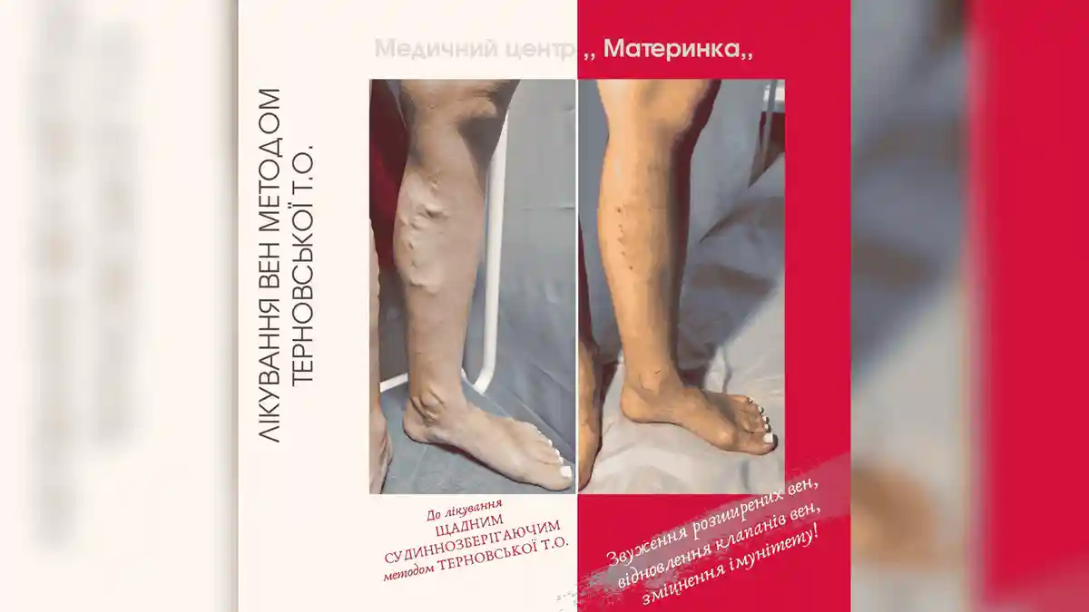 лікування вен у Кропивницькому