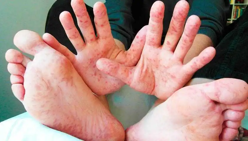 На Кіровоградщині зареєстрували сімейне вогнище кору