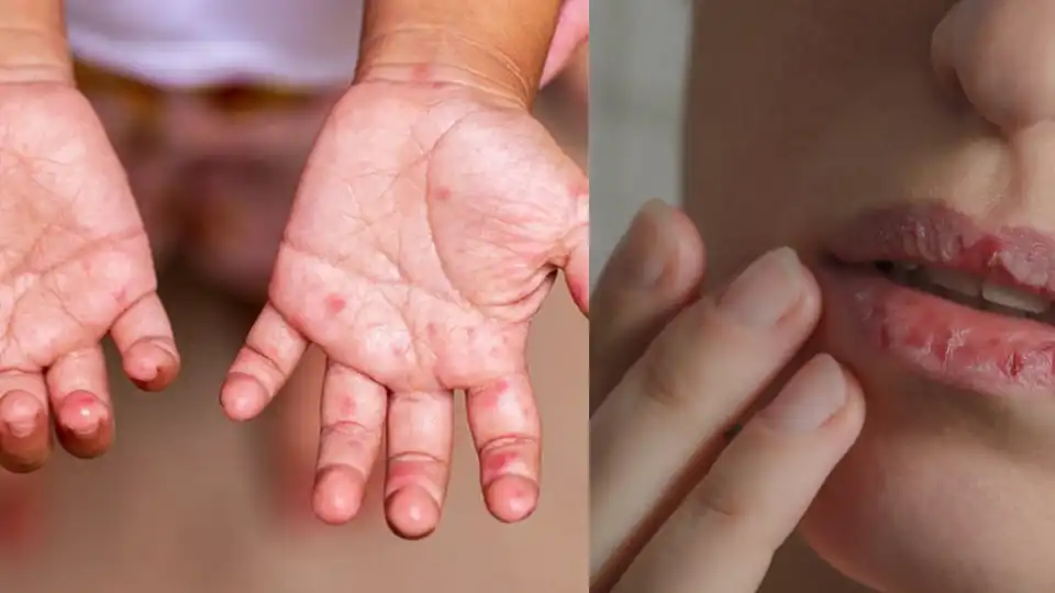 Алергічний дерматит